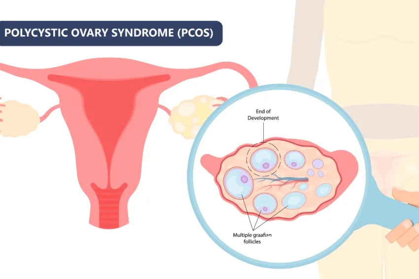 PCOS and Hirsutism: Is it Possible to Achieve Results Without Understanding Your Body?